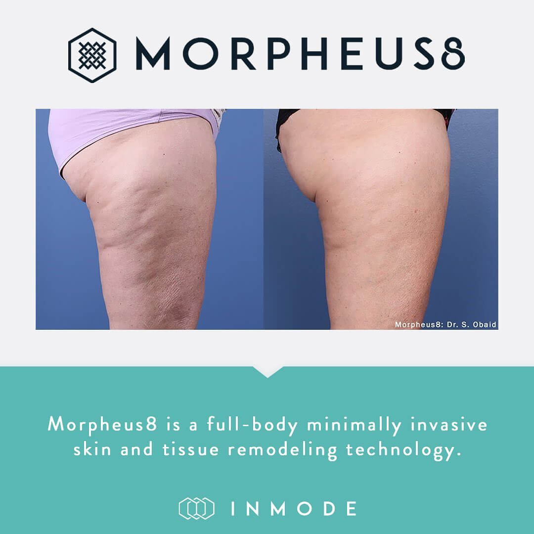 Proceduri Morpheus Body