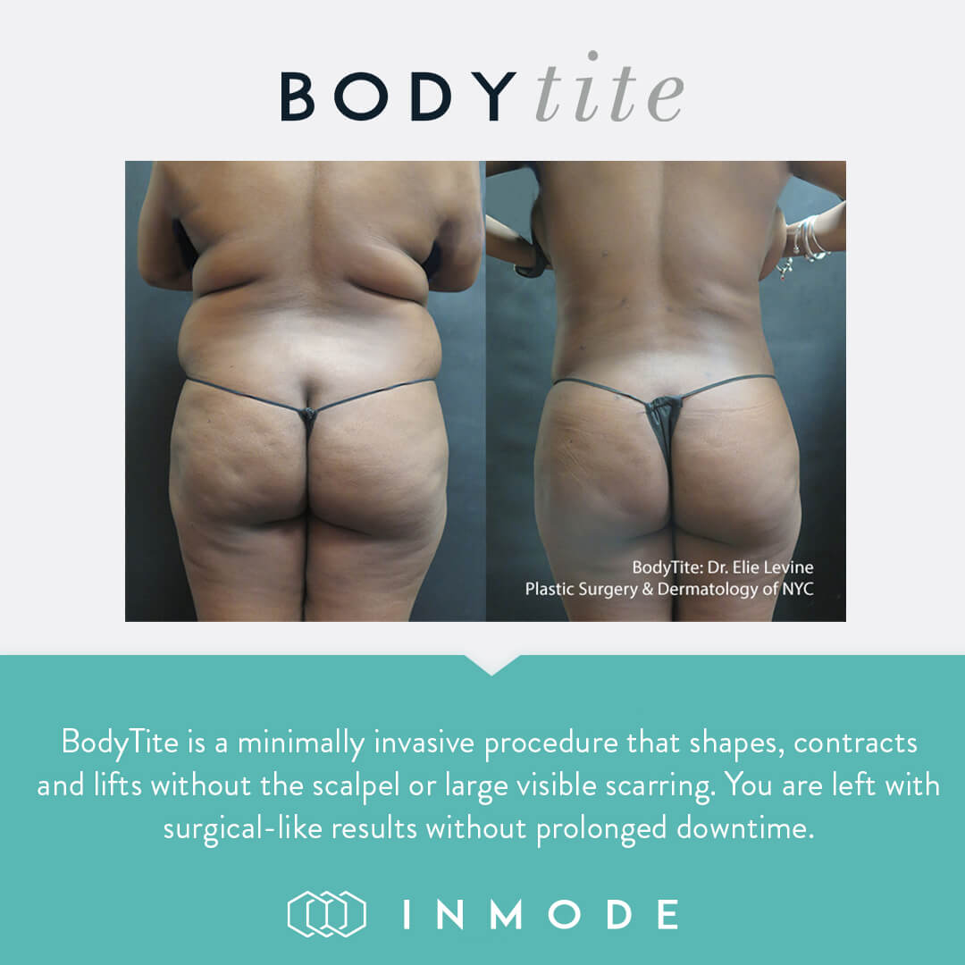 Proceduri BodyTite