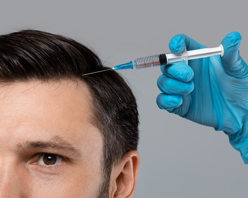 Mezoterapie Scalp
