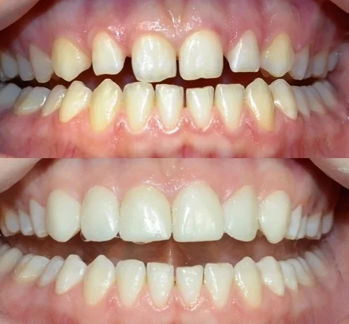 fatete-dentare-inainte-si-dupa.jpg Fațete Dentare