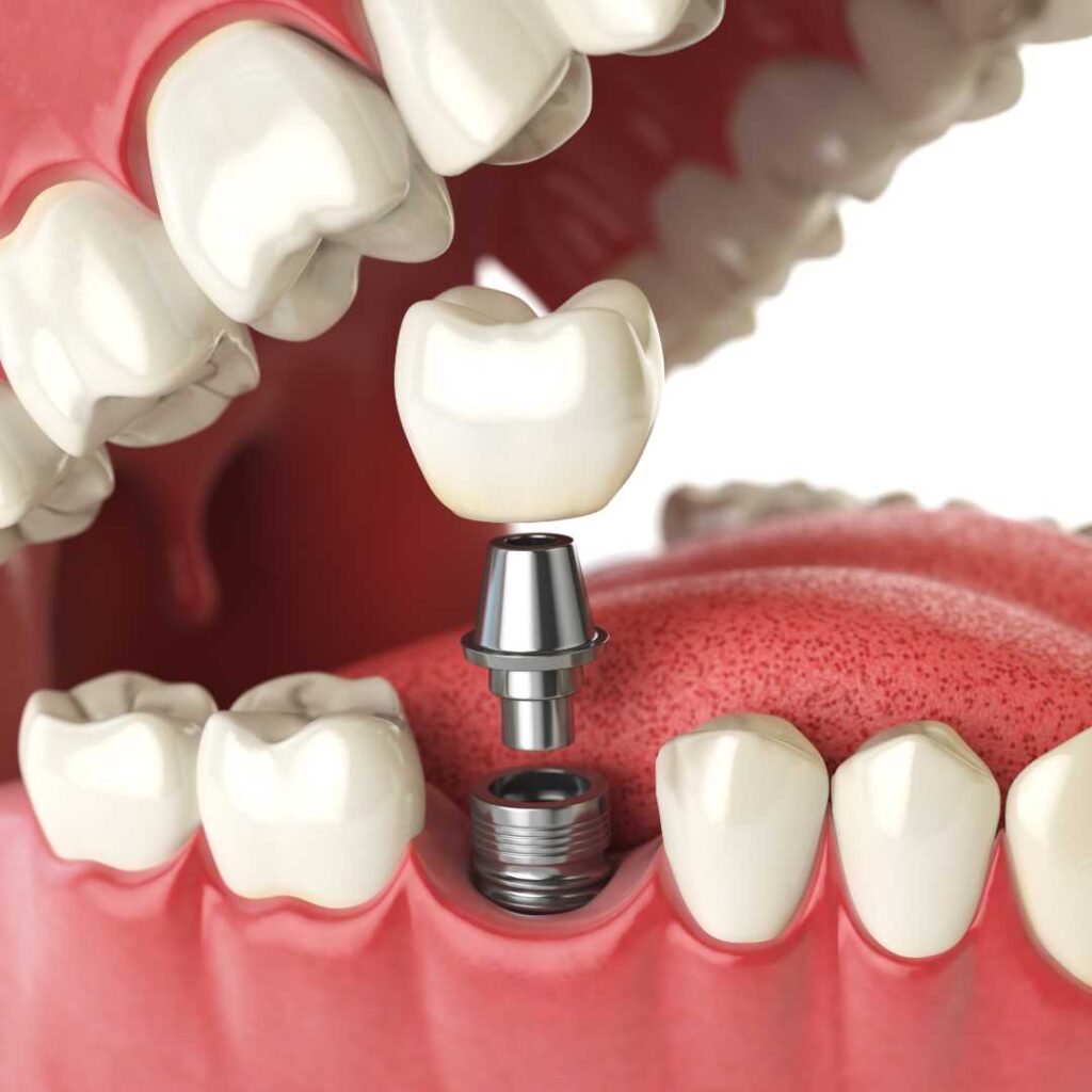 Gutiere dentare ortodontice