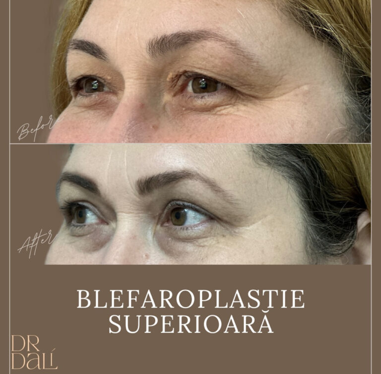 blefaroplastie-superioara-drdali-bucuresti Acasă