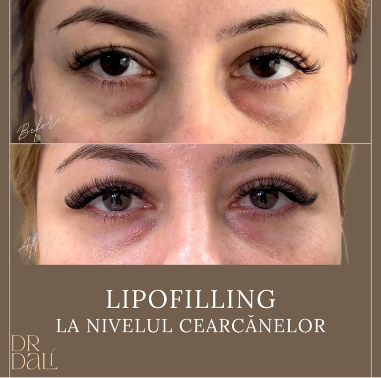 lipofilling-drdali Acasă