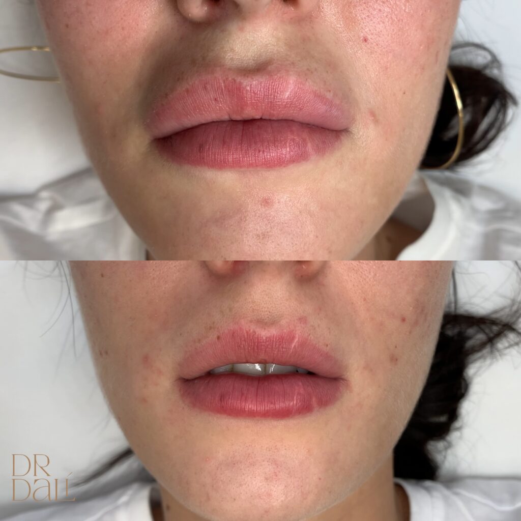Topire acid hialuronic